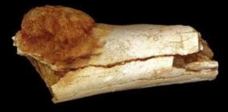 Tumore individuato in fossile di 1,7 milioni di anni fa