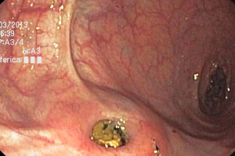  Endoscopic treatment of rectal pocket syndrome. 