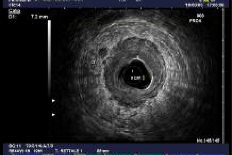  The impact of EUS to predict lymph node metastasis in patients with rectal cancer: a difficult challenge