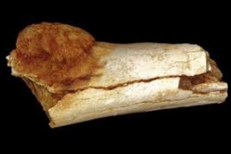 Tumore individuato in fossile di 1,7 milioni di anni fa